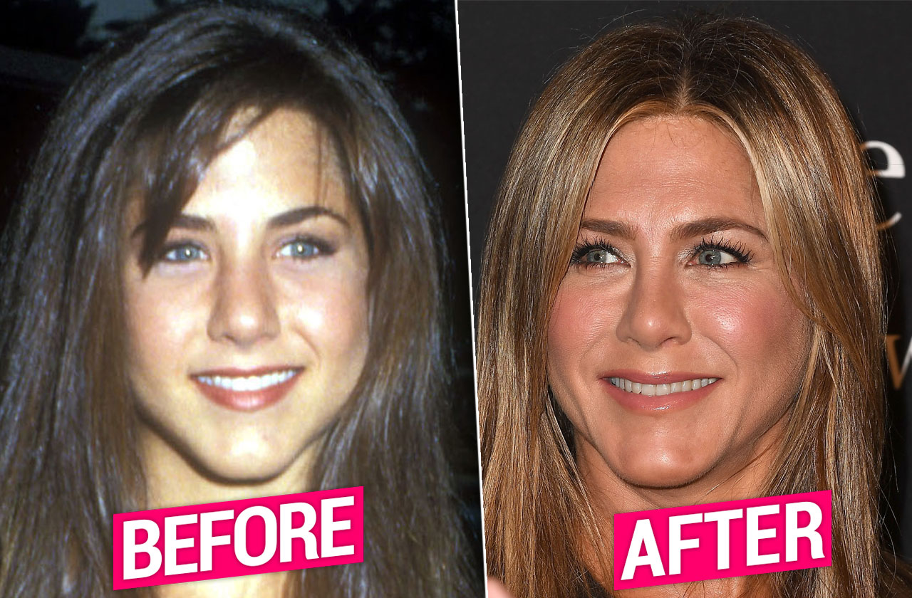 Jennifer Aniston Had Plastic Surgery? Experts Weigh In